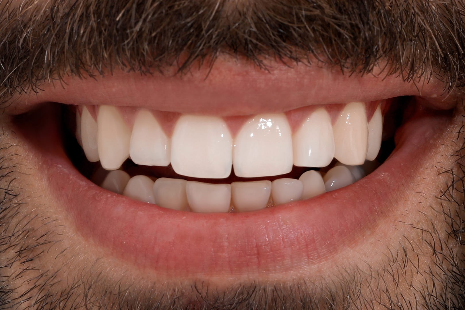 after veneer
