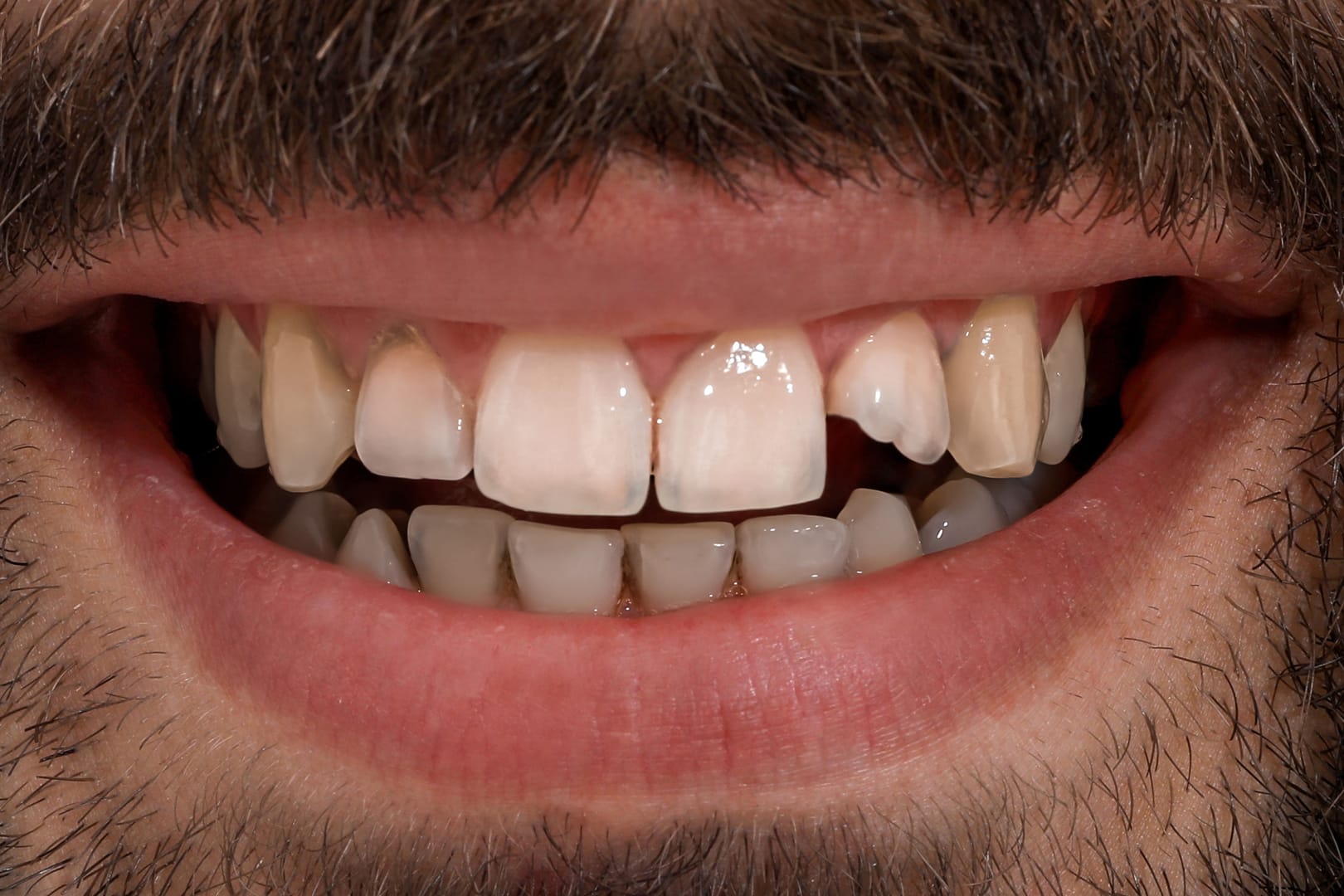 before veneer