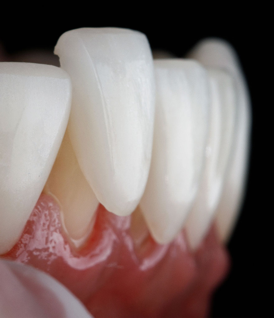 dental veneer card